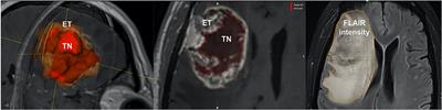 Assessment of Pre-operative Measurements of Tumor Size by MRI Methods as Survival Predictors in Wild Type IDH Glioblastoma